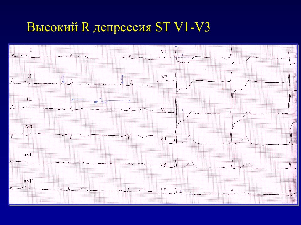 Депрессия st. Депрессия St v1-v3. Депрессия St на ЭКГ v1 v2 v3. Депрессия сегмента St v1-v3. Депрессия в отведениях v1-v3.