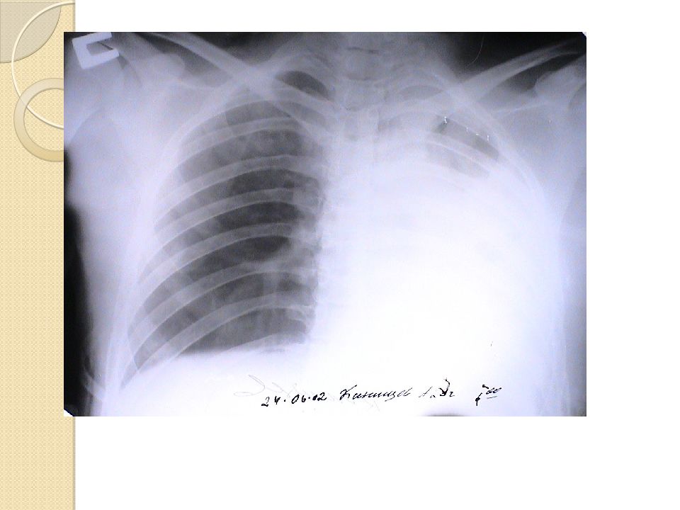Травма грудной клетки хирургия презентация