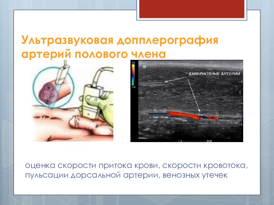 Исследование артерий. Протокол УЗИ сосудов полового члена. УЗДГ сосудов полового члена. Допплерография сосудов полового члена. Ультразвуковая допплерография сосудов полового члена.