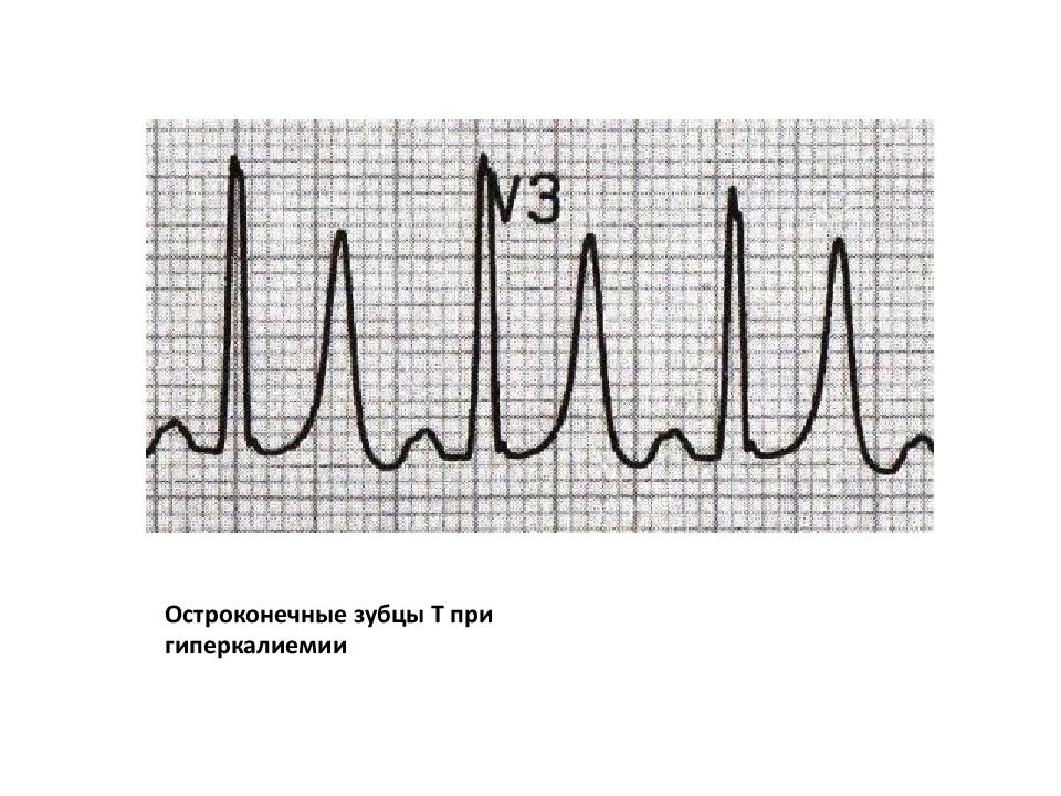 Экг при гиперкалиемии картинки