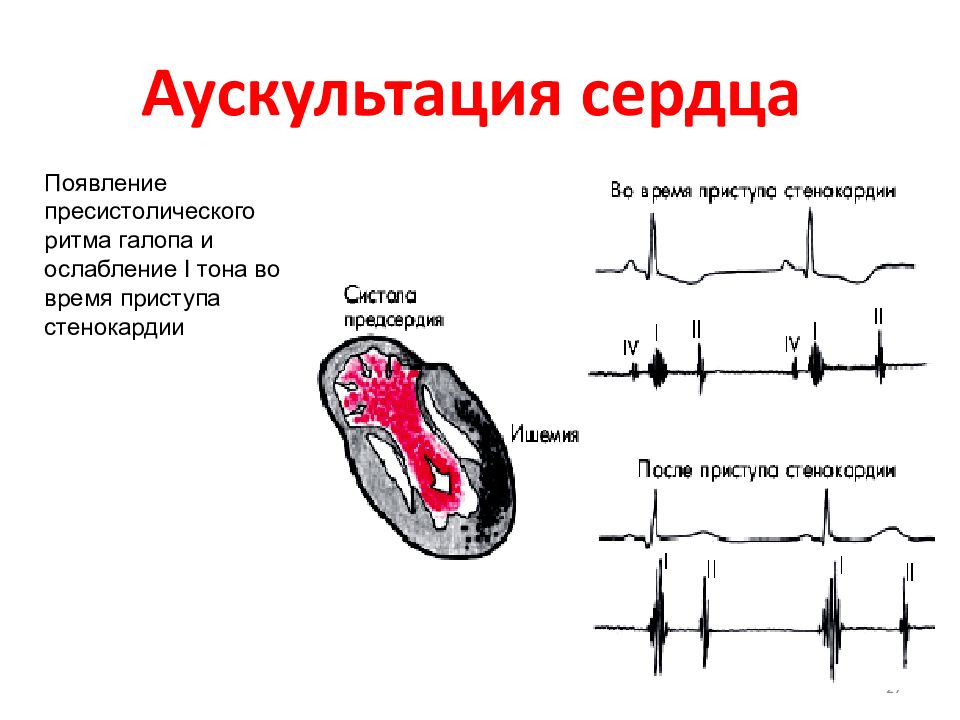 Появление сердца. Аускультация при инфаркте миокарда. Инфаркт миокарда аускультация сердца. Аускультация при нестабильной стенокардии. Для стенокардии напряжения при аускультации характерны.