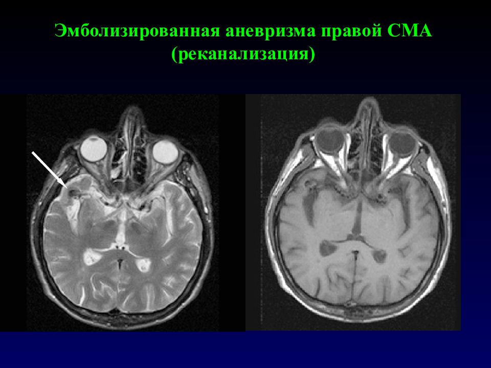 Мешотчатая аневризма. Мешотчатая аневризма правой СМА. Аневризмы левой СМА ( сегмент м1). Аневризма средней мозговой артерии мрт.