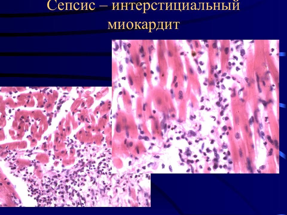 Сепсис патанатомия презентация
