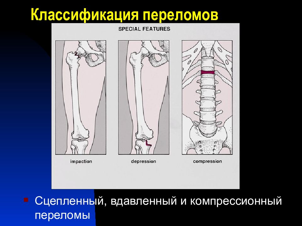 Классификация переломов. Компрессионный перелом классификация. Классификация скелетной травмы. Вдавленные переломы классификация. Классификация переломов по автору.