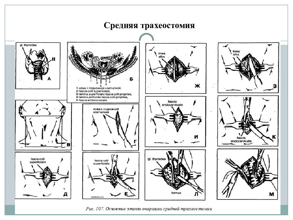 Трахеостомия Оперативная хирургия. Трахеостомия инструменты для операции. Протокол операции трахеостомии.