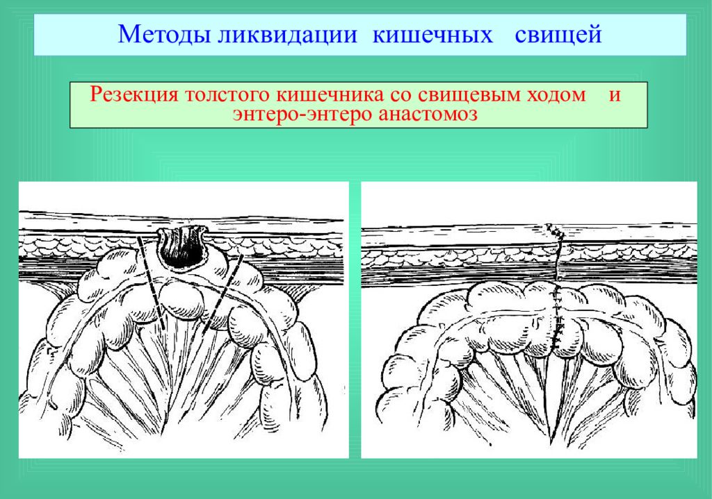 Лечение кишечных свищей