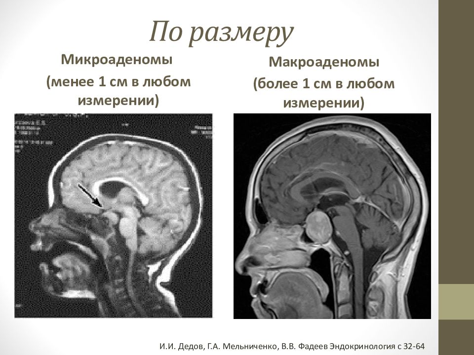 Аденома гипофиза презентация