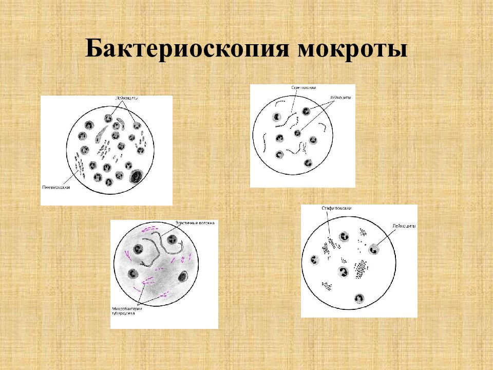 Исследование мокроты. Бактериоскопическое бактериоскопическое исследование мокроты. Бактериоскопия мокроты. Бактериоскопический анализ мокроты. Бактериоскопические методы исследования мокроты.