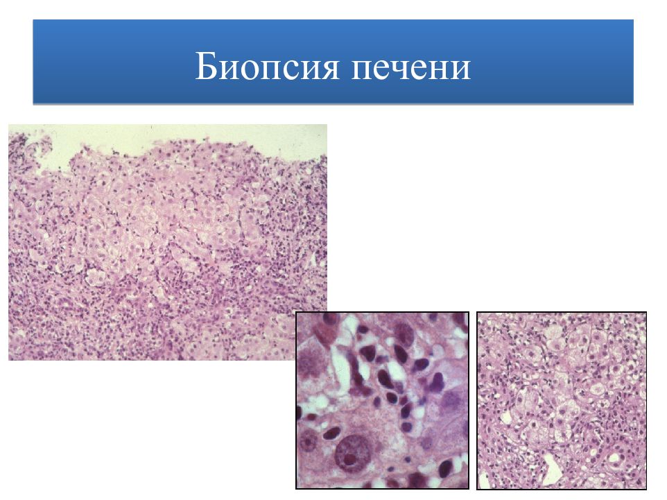 Аутоиммунный гепатит картинки