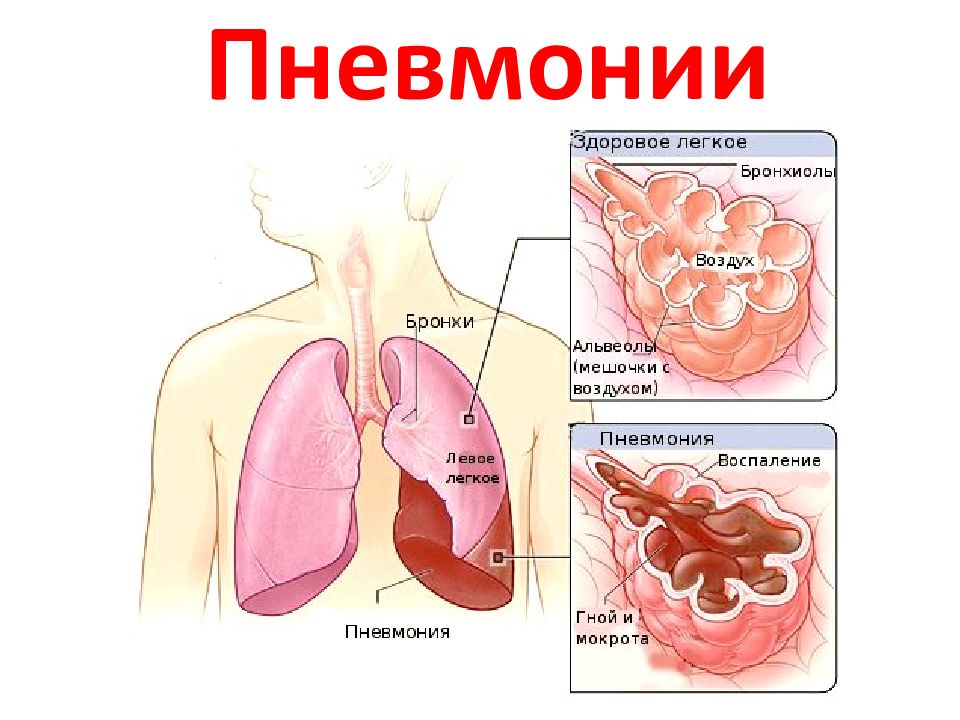 Болезнь в легких мокрота