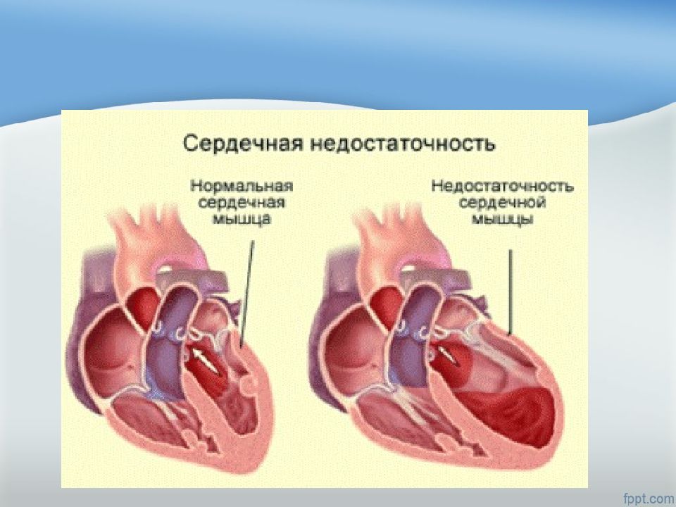 Заболевание сердца сопровождающееся сердечной недостаточностью. Сердечно-сосудистая недостаточность. Сердечная недостаточность. Острая сердечная недостаточность. Острая сердечная сосудистая недостаточность.