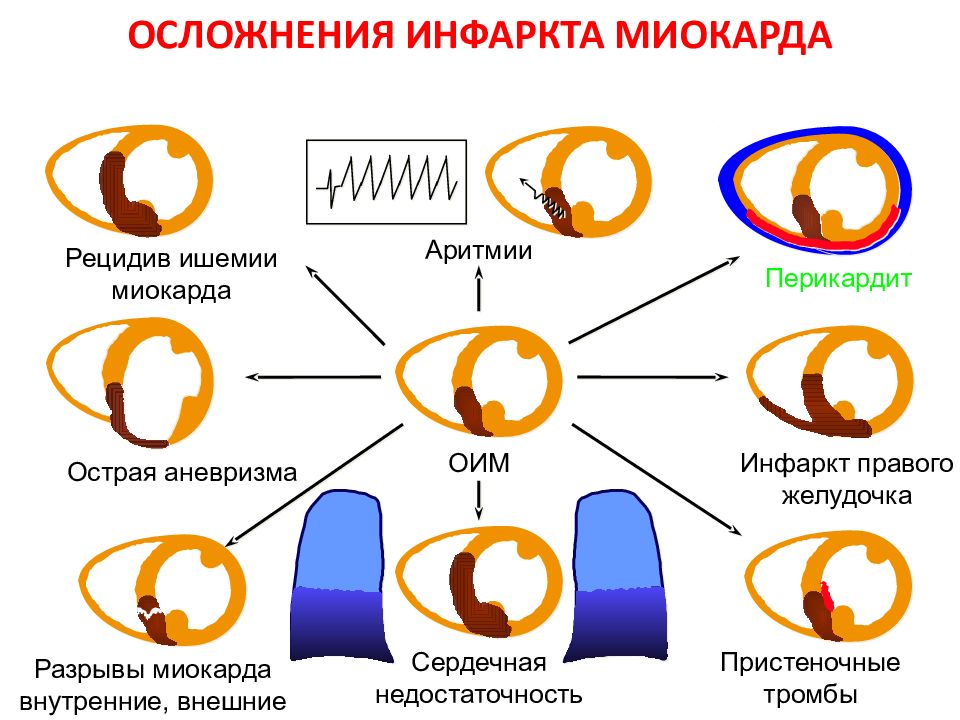 Инфаркт последствия. Ранние и поздние осложнения инфаркта миокарда. Осложнения раннего и позднего периода инфаркта миокарда. Осложнения острого инфаркта миокарда классификация. Осложнения острейшего и острого периодов инфаркта миокарда.