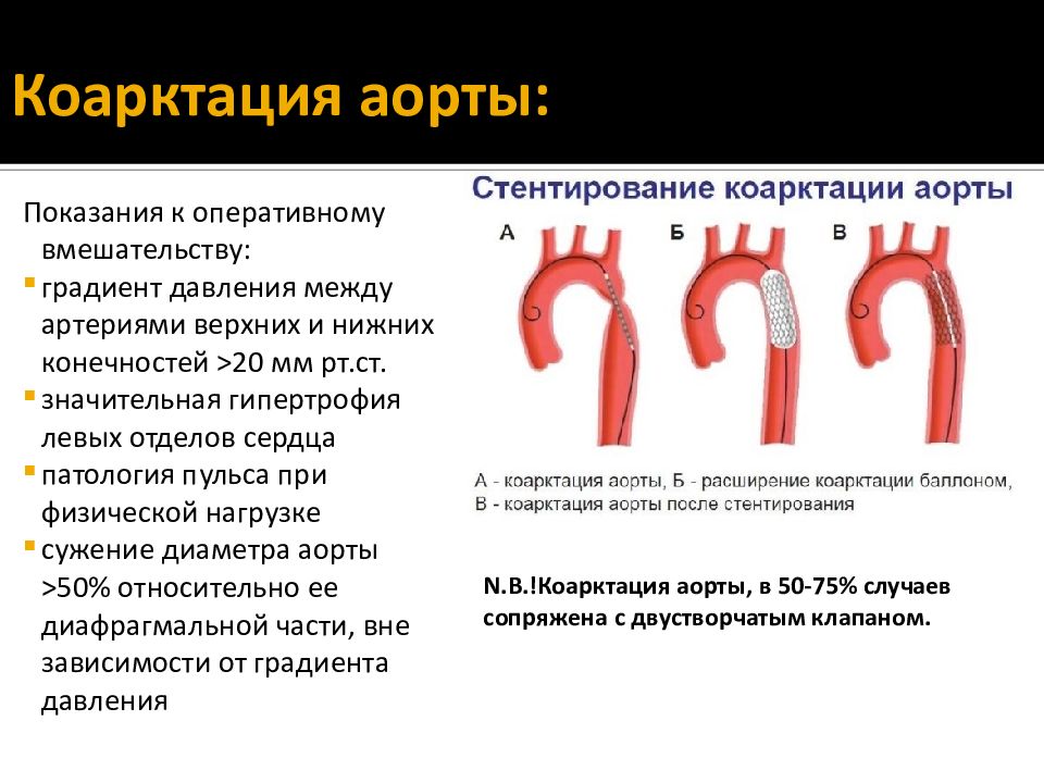 Коарктация аорты картинки