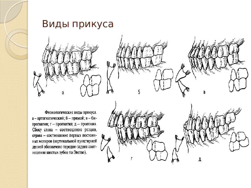 Виды прикуса картинки