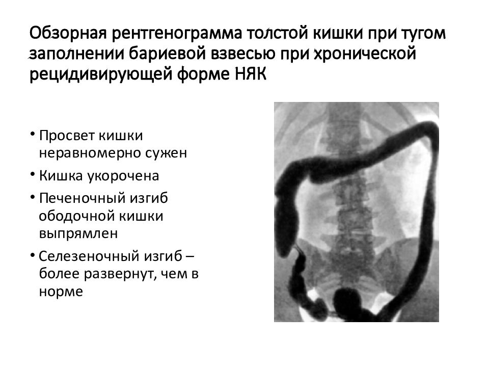 Колит симптомы. Заболевания ободочной кишки няк. Кт колоноскопия кишечника неспецифический язвенный колит. Основные симптомы хронического колита. Хронический колит кишечника на рентгене.