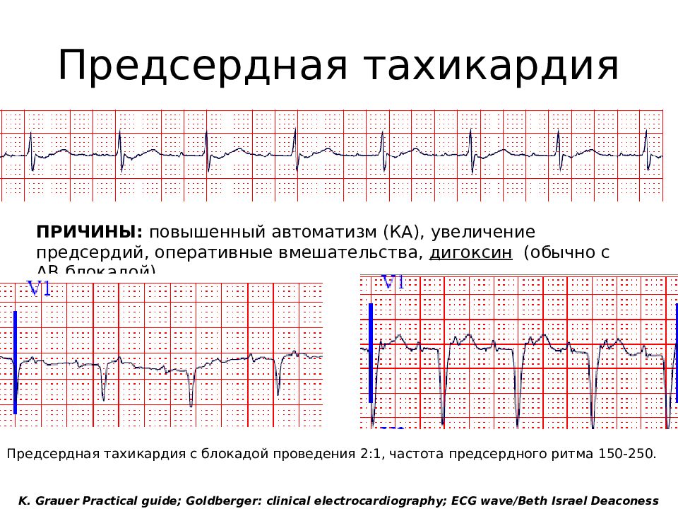 Предсердная тахикардия. Предсердная тахикардия с АВ блокадой 2 степени на ЭКГ. Полиморфная предсердная тахикардия. ЭКГ критерии предсердной тахикардии. Предсердная тахикардия на ЭКГ признаки.