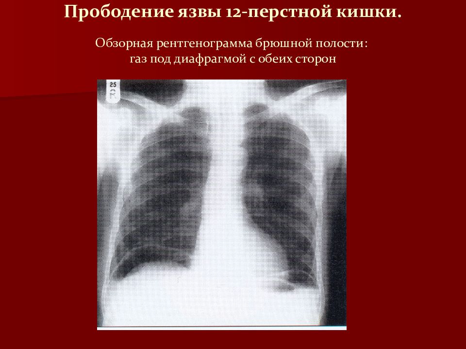 прободение это. прободение это. прободение при язвенной болезни желудка. клиническая картина перфоративной язвы. прободение язвы желудка осложнения.