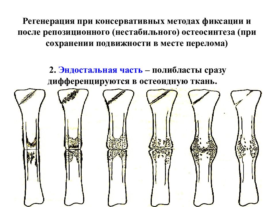 Эндостальная мозоль. Эндостальная костная мозоль рентген. Репозиционный остеосинтез. Нестабильный остеосинтез отломков.