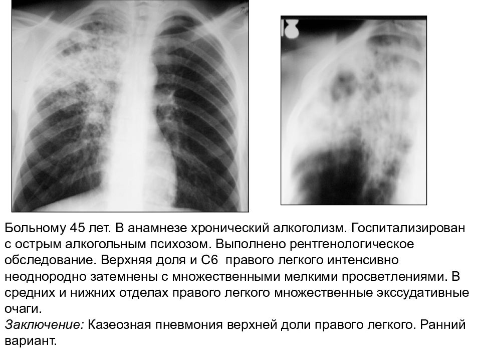 долевая пневмония в верхней доле правого легкого 1 и 2 стадии. пневмония в верхних долях легких. пневмония в верхних долях легких. пневмония в верхних долях легких. пневмония в верхних долях легких.