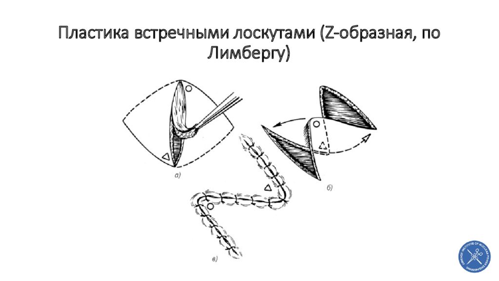 Треугольный лоскут. Пластика встречными треугольными лоскутами по Лимбергу. Пластика встречными лоскутами. Пластика по Лимбергу. Пластика по Лимбергу встречными лоскутами.