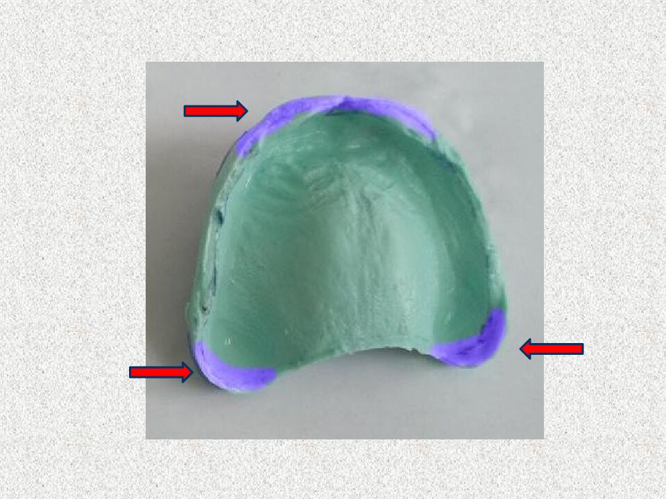 Funksional otisklar uchun individual qoshiqchalar