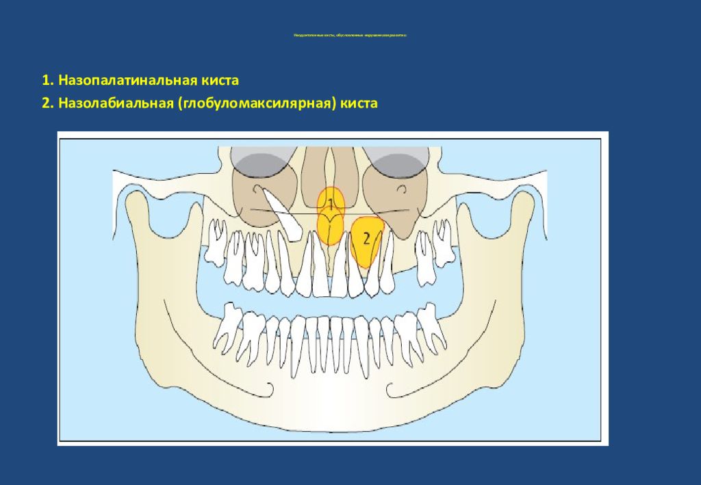 Неодонтогенные кисты презентация