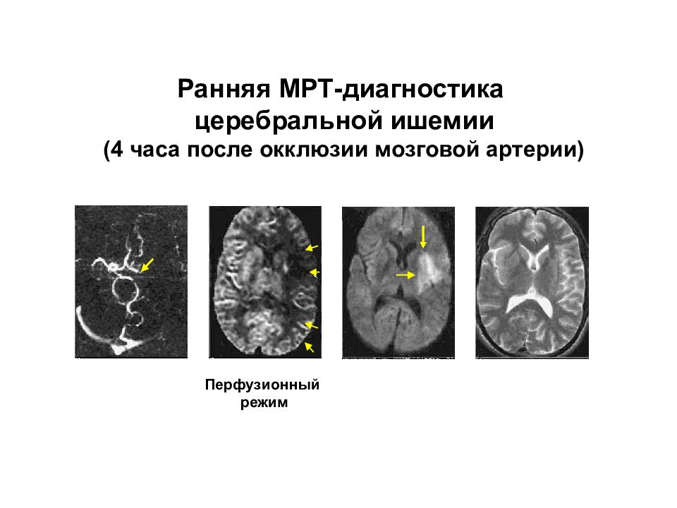 Церебральная ишемия у новорожденного 2. Энцефалопатия на кт мозга. Окклюзия артерий головного мозга мрт. Ишемия головного мозга мрт т2. Дисциркуляторная энцефалопатия мрт.