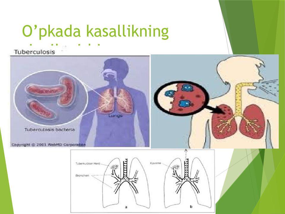 O'PKA OBSTRUKTIV YETISHMOVCHILIGI DIAGNOSTIKASI O’pkada kasallikning rivojlanishi