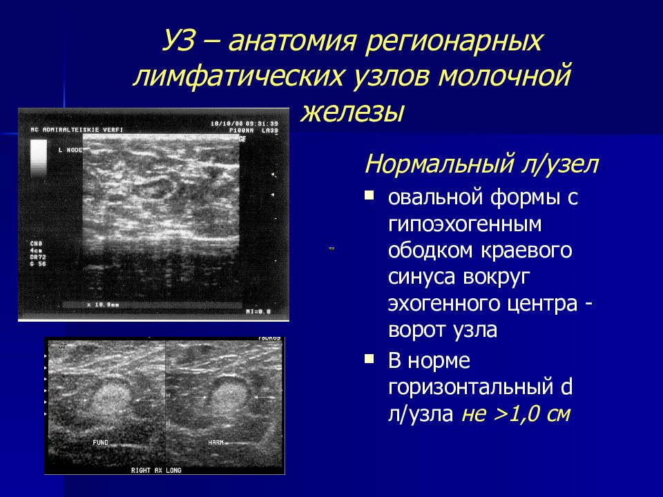 Узи молочных желез на какой цикл. Структура молочной железы на УЗИ. Тип строения молочных желез УЗИ. УЗИ лимфатических узлов норма. Интрамаммарный лимфатический узел УЗИ.