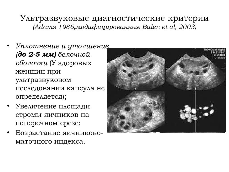 Поликистоз яичников что это. Синдром гиперторможения яичников УЗИ. Ультразвуковые критерии поликистозных яичников. Поликистоз яичников УЗИ критерии.