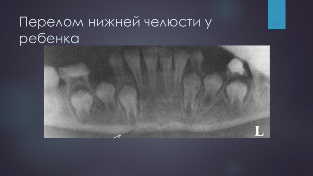 Переломы верхней челюсти у детей презентация