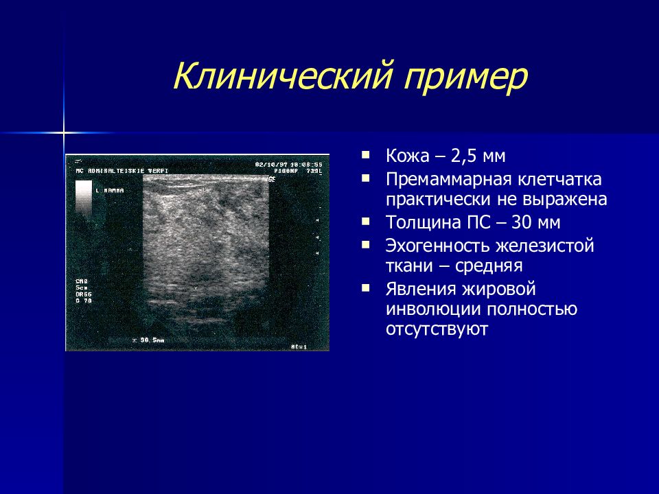 Клиническая железа. Толщина железистой ткани молочной железы. Эхогенность железистой ткани молочной железы. УЗИ молочных желез железистая ткань. Ультразвуковая анатомия молочной железы.