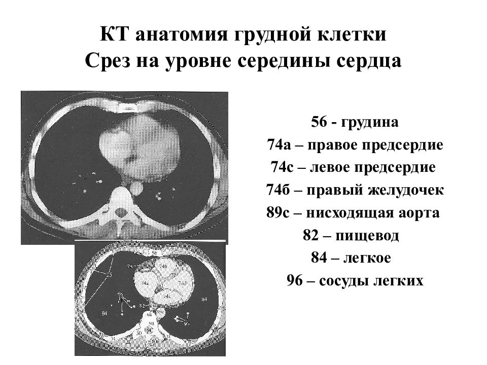 Кт клетки. Кт органов грудной клетки с обозначениями. Кт срезы грудной клетки. Строение сердца на кт. Кт грамма нормальной грудной клетки.