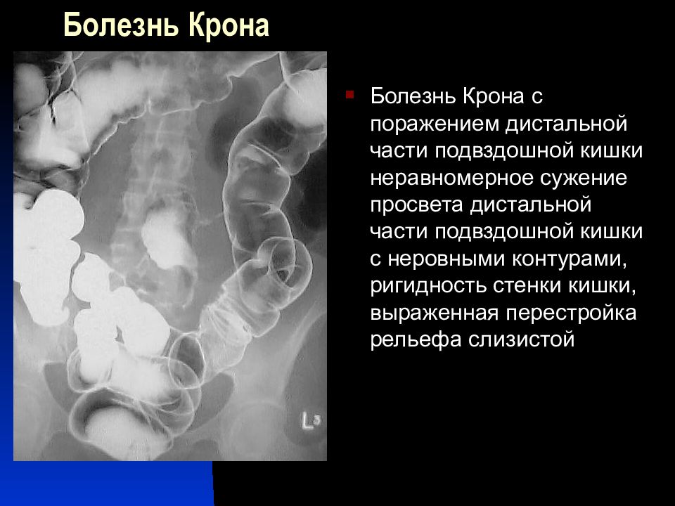 Дистальный отдел прямой кишки. Болезнь крона диагностика рентгенологические. Болезнь крона толстой кишки. Болезни подвздошной кишки. Кишка при болезни крона.