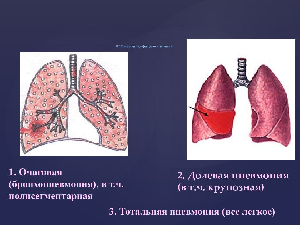 Пневмония очаговая презентация