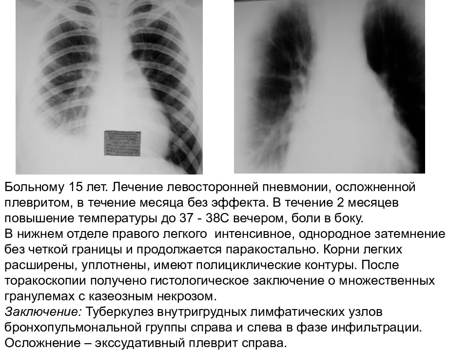 Экссудативный плеврит при пневмонии. Плеврит при пневмонии рентген. Плеврит и пневмония на рентгене. Левосторонний экссудативный плеврит осложнения. Экссудативный плеврит рентген.