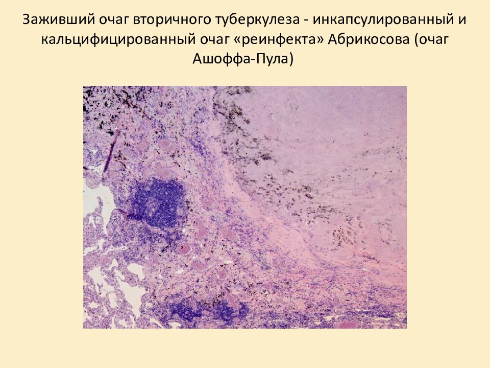 Туберкулезная каверна микропрепарат рисунок