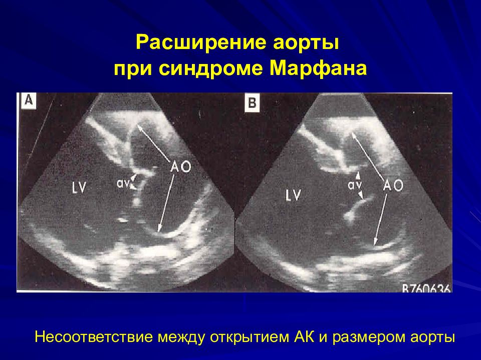 Расширение аорты сердца