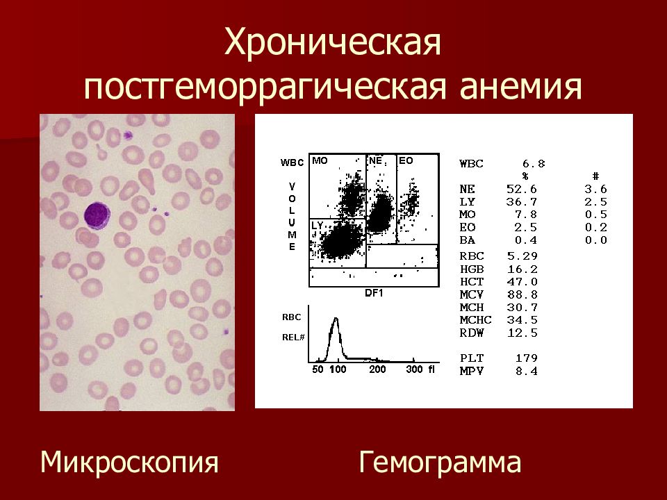 Для железодефицитной анемии характерна такая картина периферической крови