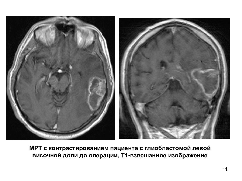 Опухоли нервной системы неврология презентация