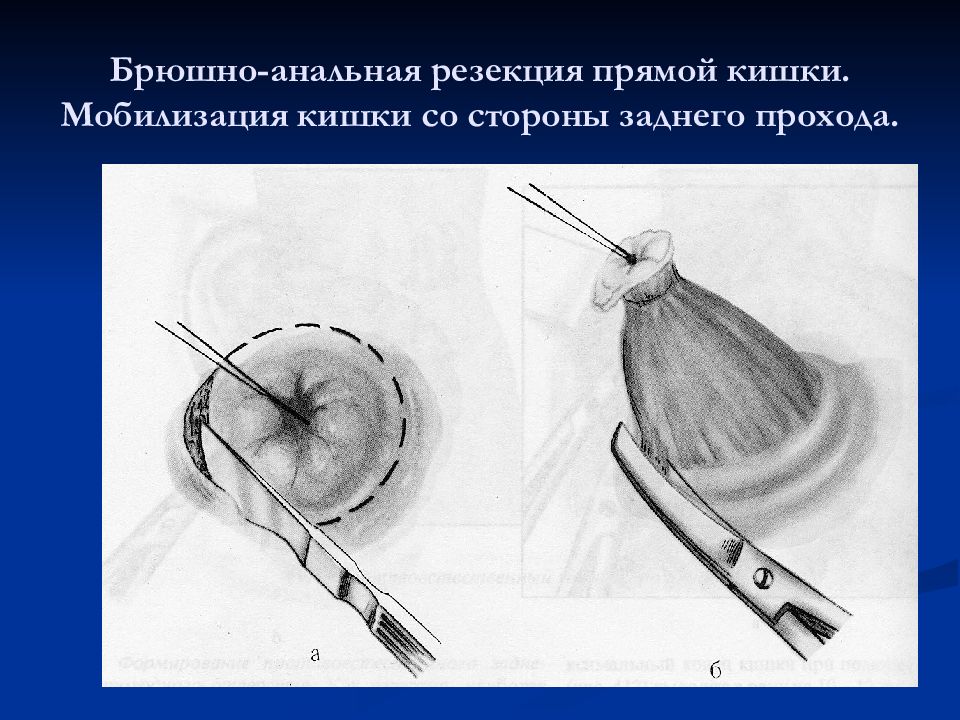 Секторальная резекция. Резекция и экстирпация прямой кишки. Брюшноанальная резекция прямой кишки. Брюшноанальную экстирпацию прямой кишки. Колоректальная резекция.