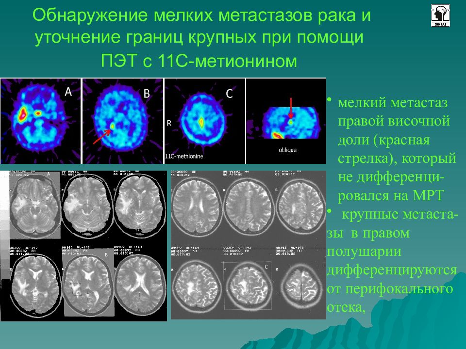 Позитронно эмиссионная томография презентация