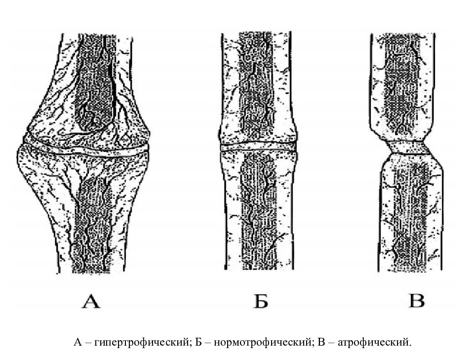 Костная мозоль этапы