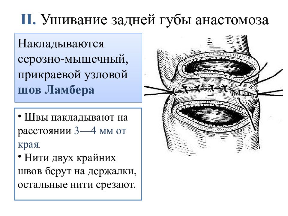 Кишечные анастомозы презентация