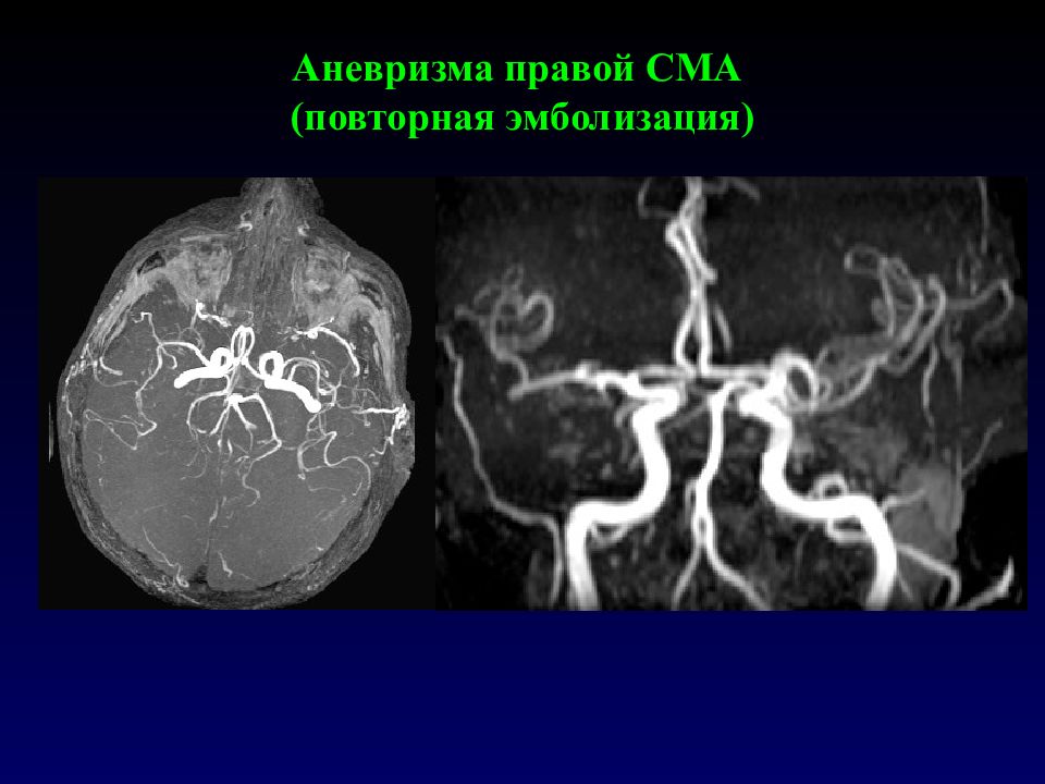 Презентация аневризмы сосудов головного мозга