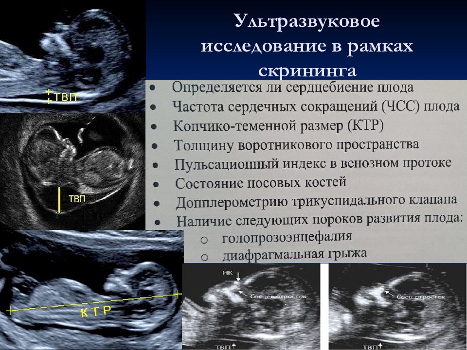 Толщина воротниковой зоны. Воротниковое пространство плода 12 недель норма. Толщина воротникового пространства 1 скрининг норма. Воротниковое пространство при синдроме Дауна. Воротниковое пространство на 1 скрининге.