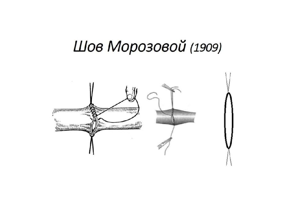 Сосудистый шов история. Инвагинационный сосудистый шов.