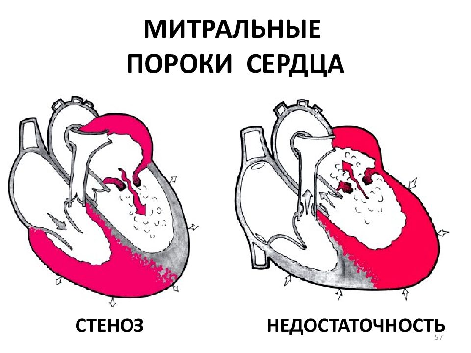 Митральный стеноз презентация