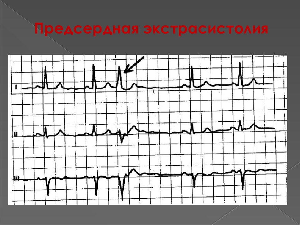Что такое экстрасистолия сердца. Предсердная экстрасистолия. Предсердные экстрасистолы на ЭКГ. Предсердная экстрасистолия ритм. Частые предсердные экстрасистолы.