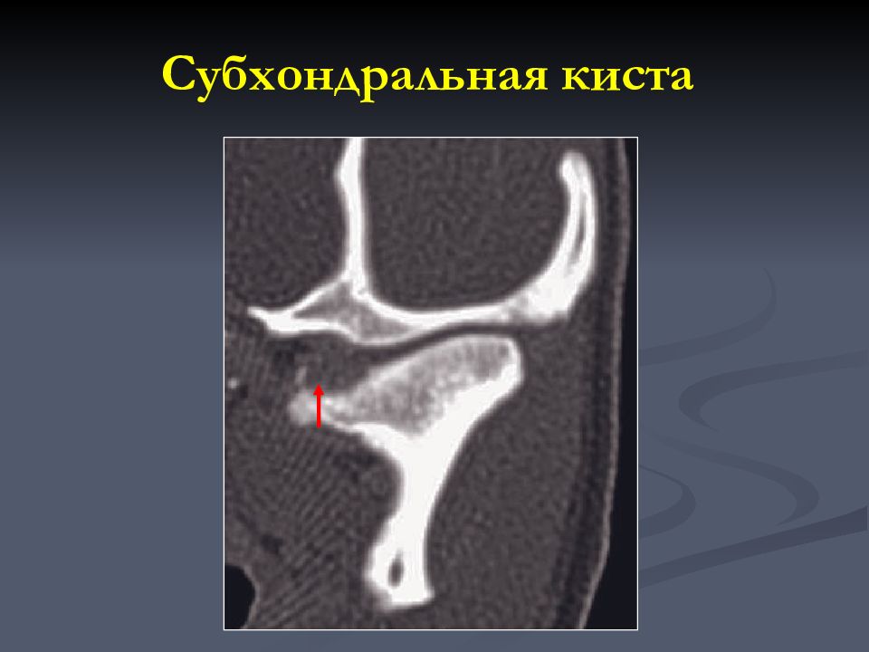 Субхондральную костную ткань